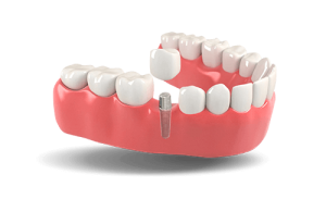 Dental implants model