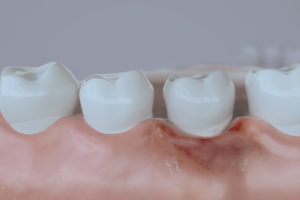 advanced periodontal disease illustration