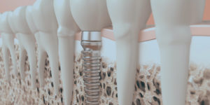 Bone grafting illustration