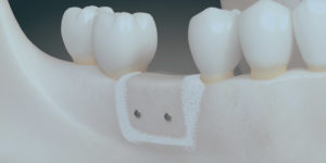 Bone grafting illustration