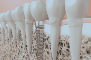 Bone grafting to treat severe bone loss