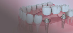 Dental implant prosthetic